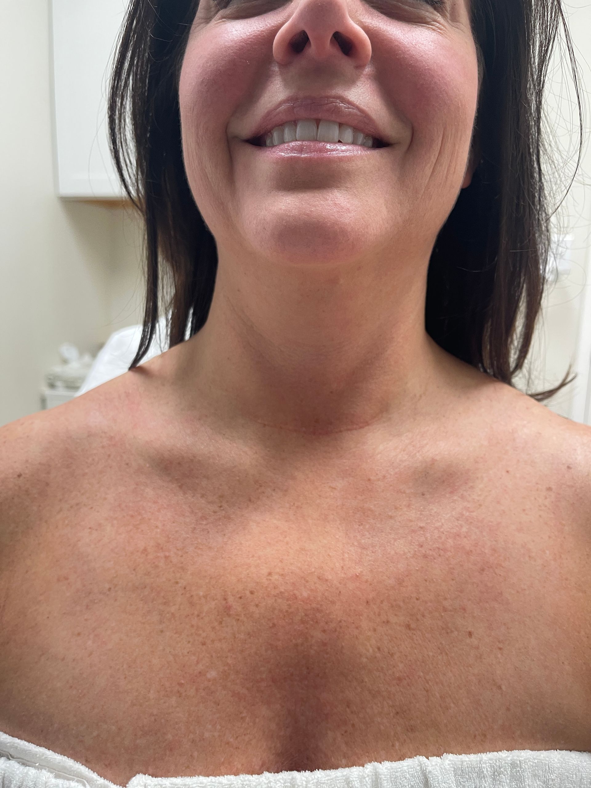 Venus Freeze Neck Treatment