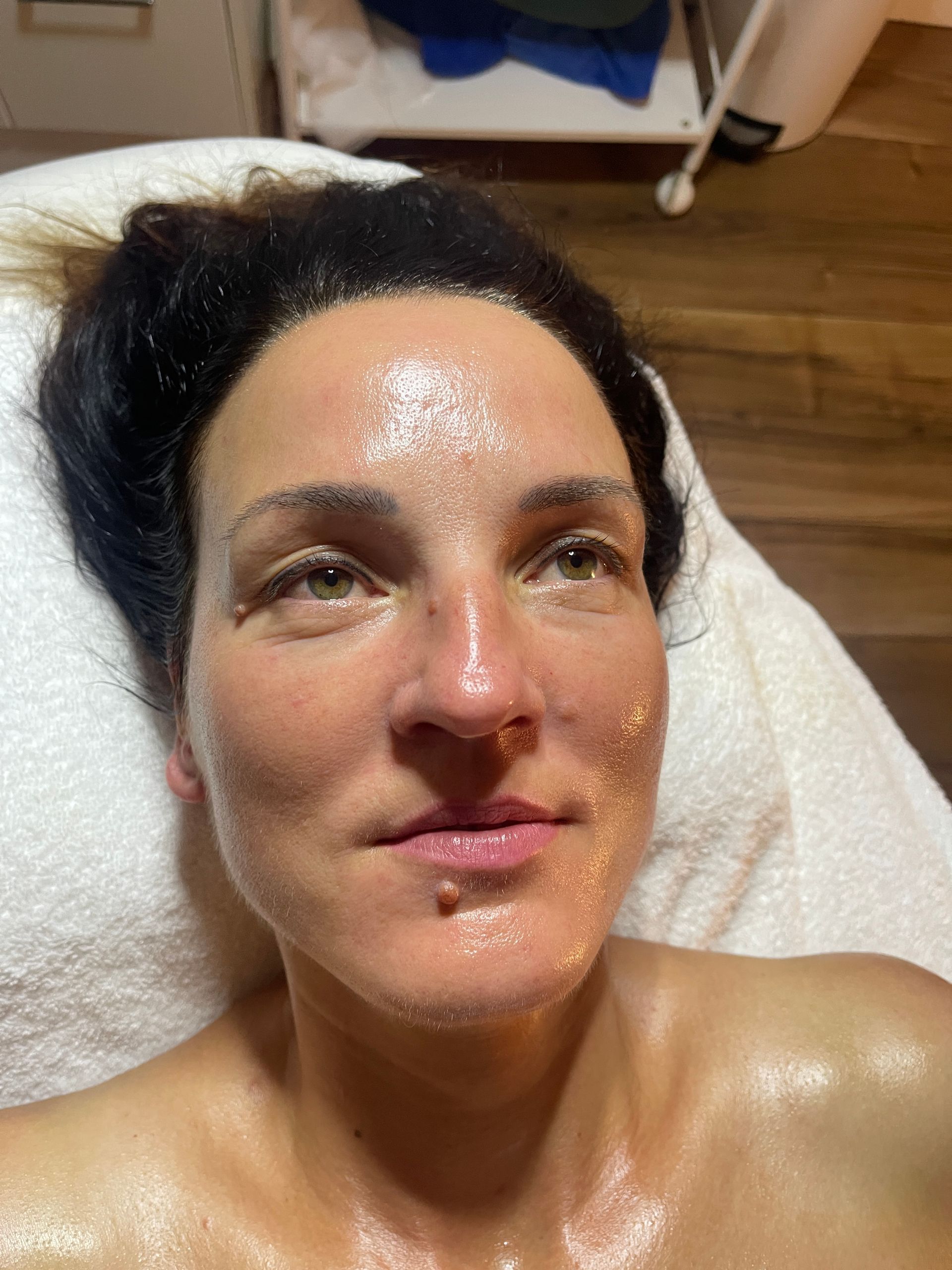 Venus Freeze Treatment 