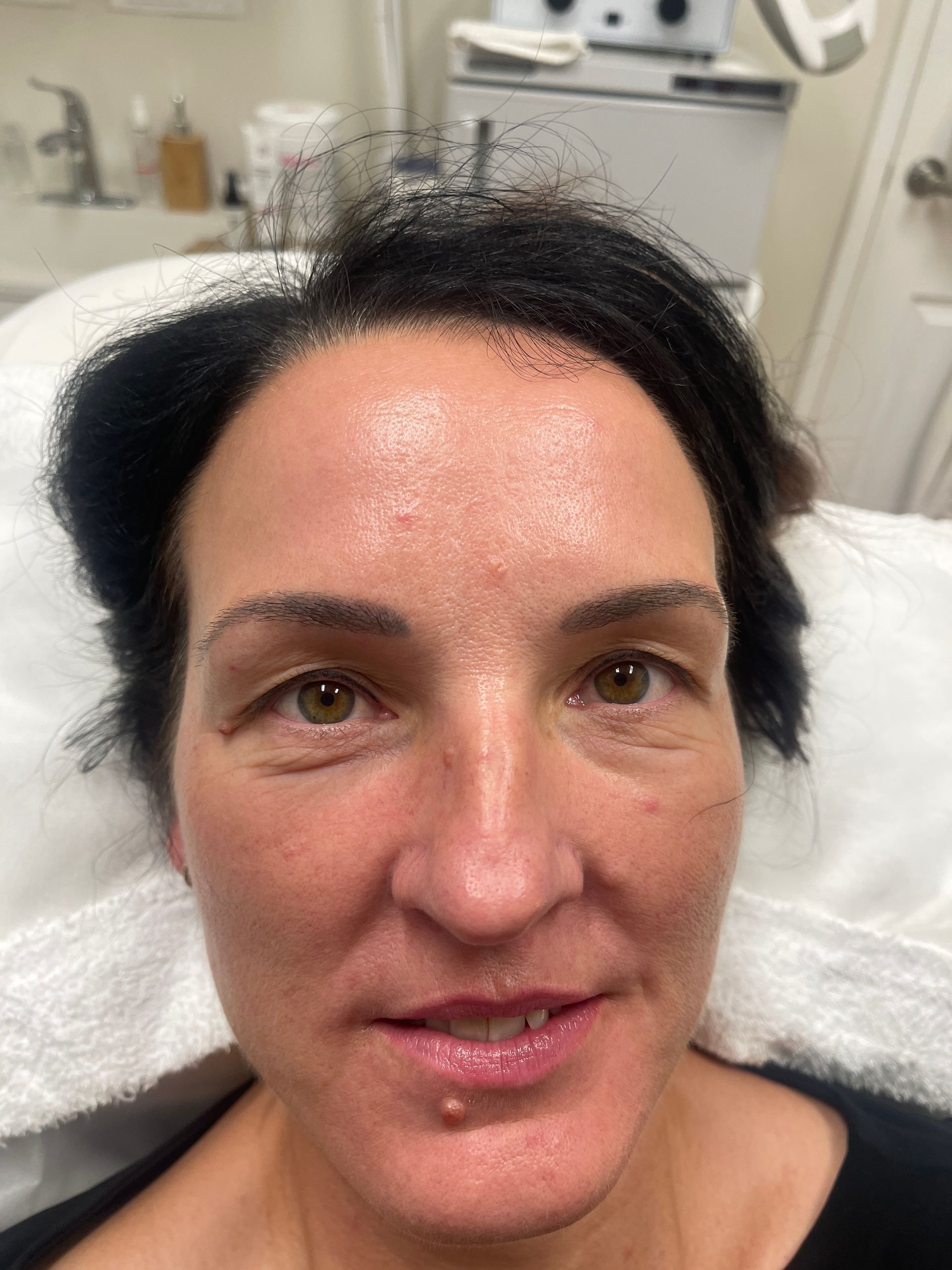 Venus Freeze Treatment 