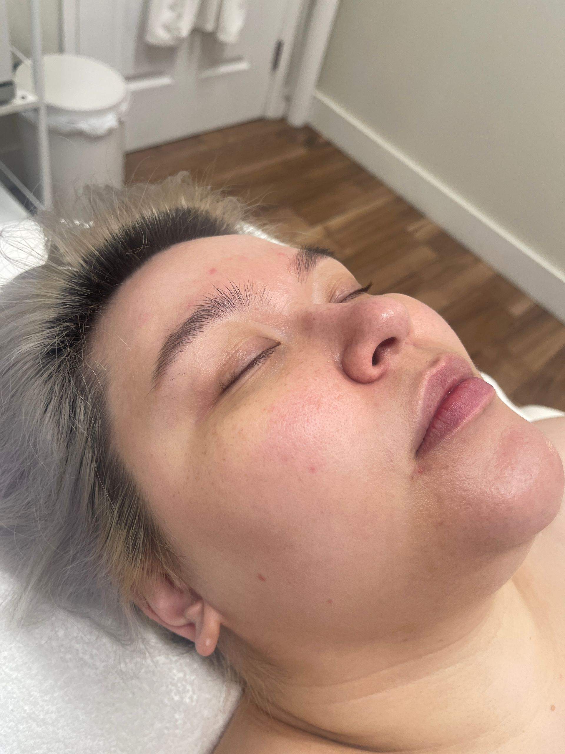 IPL Treatment 