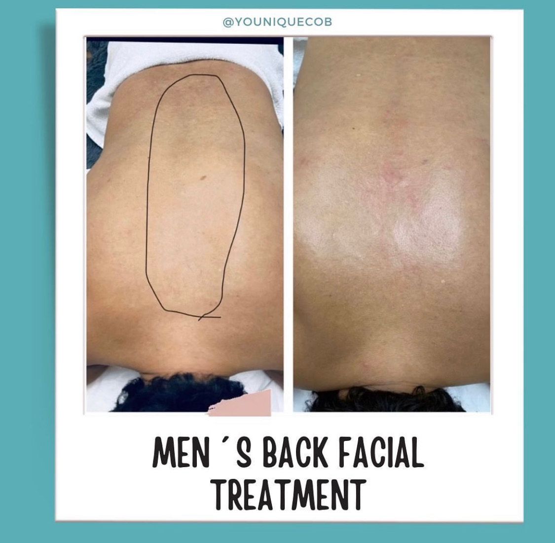Men's Back Facial Treatment