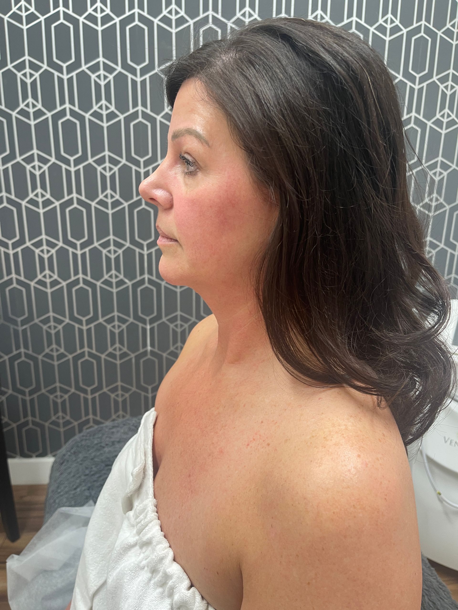 Venus Freeze Neck Treatment