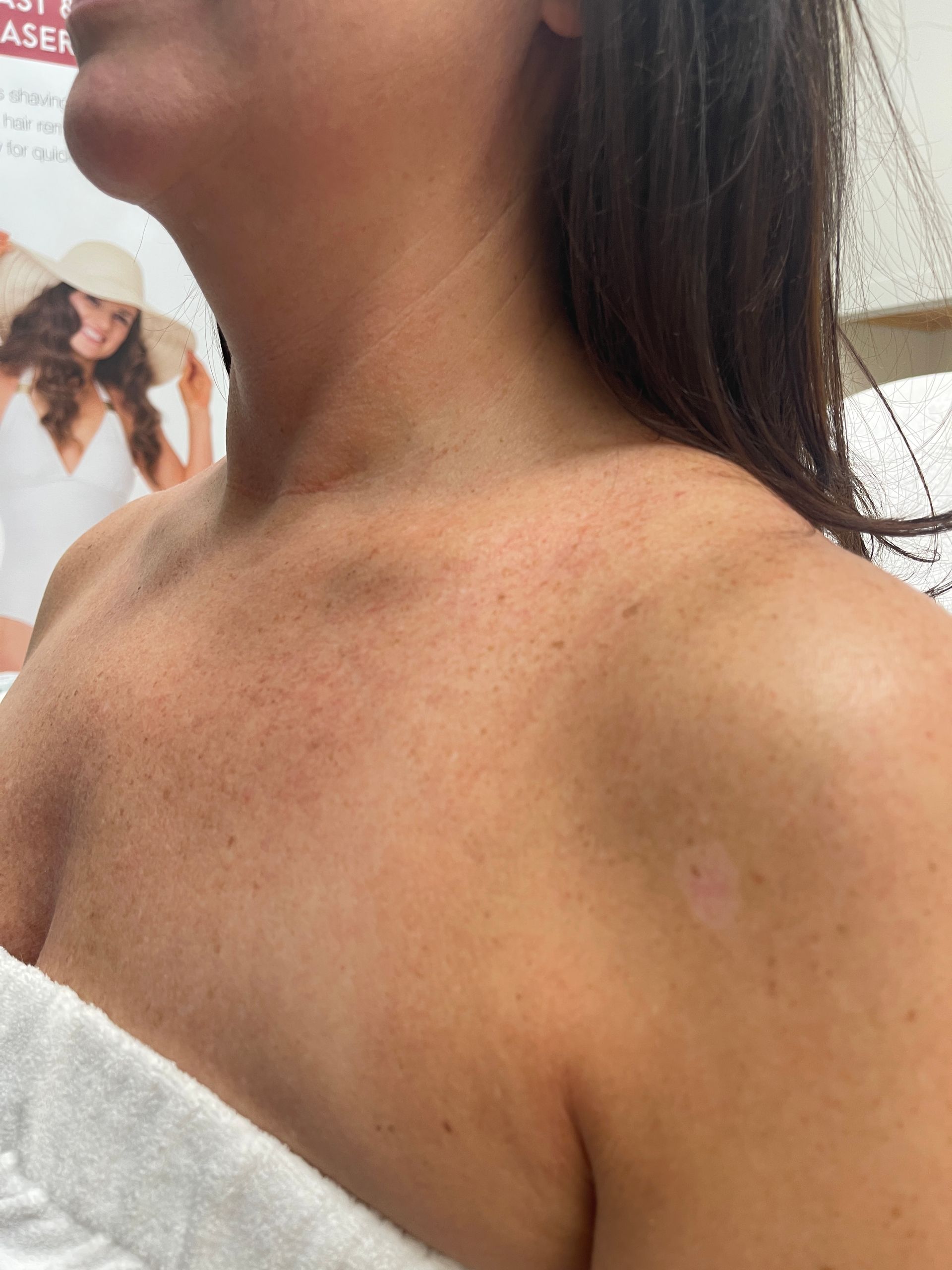 Venus Freeze Neck Treatment