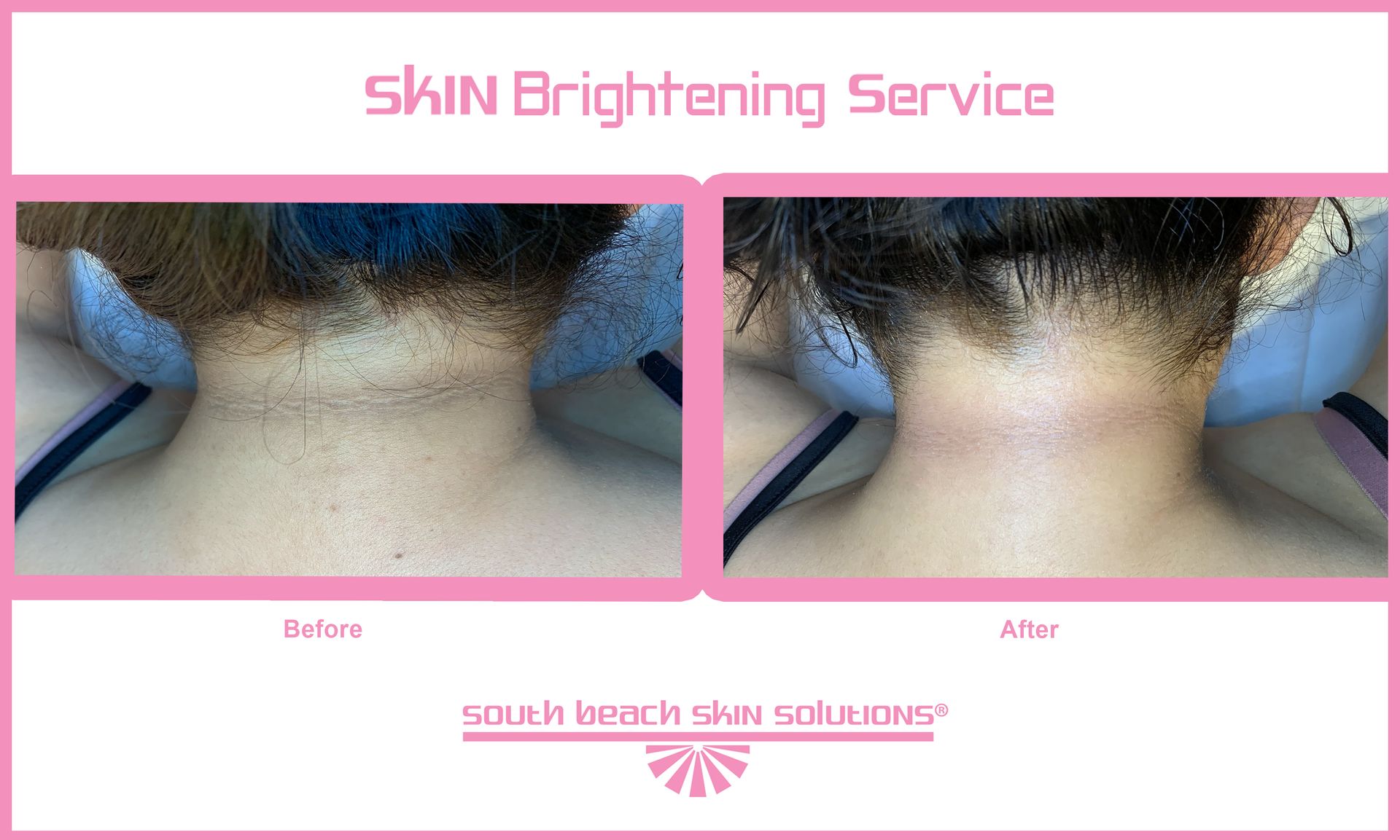 A woman 's neck before and after a skin brightening service.