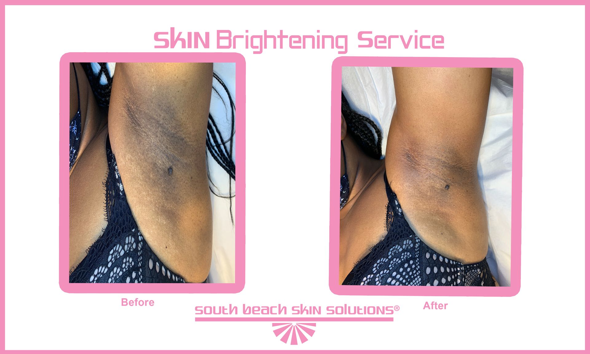 A woman 's underarm before and after a skin brightening service