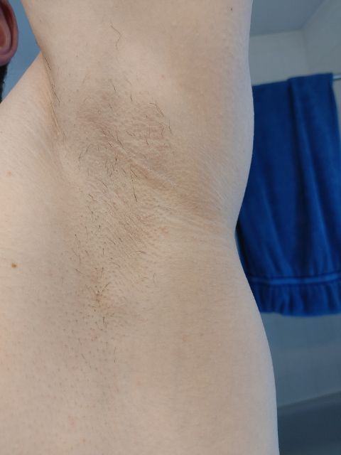 Laser body treatment