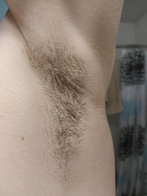 Laser body treatment