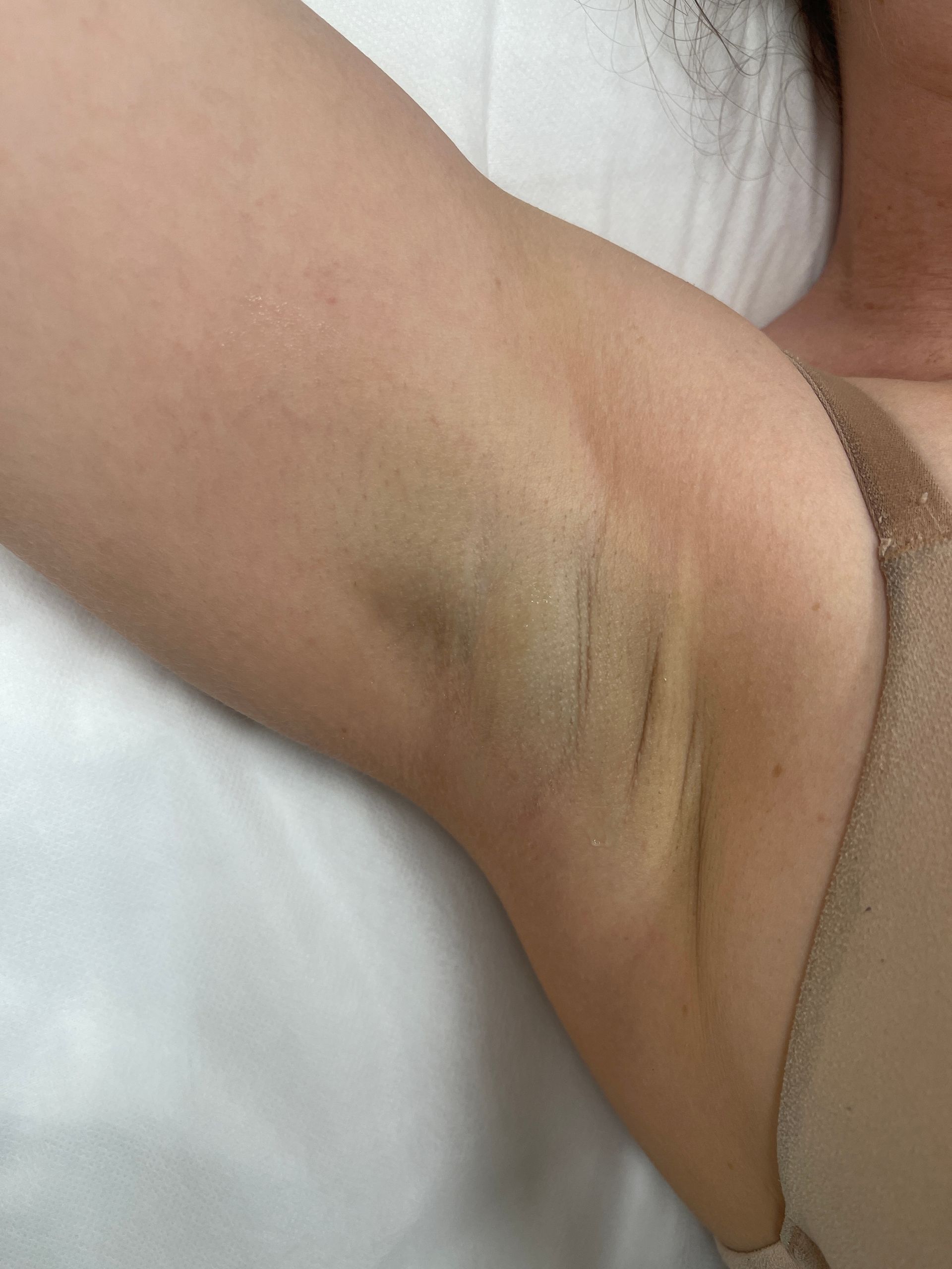 Laser body treatment