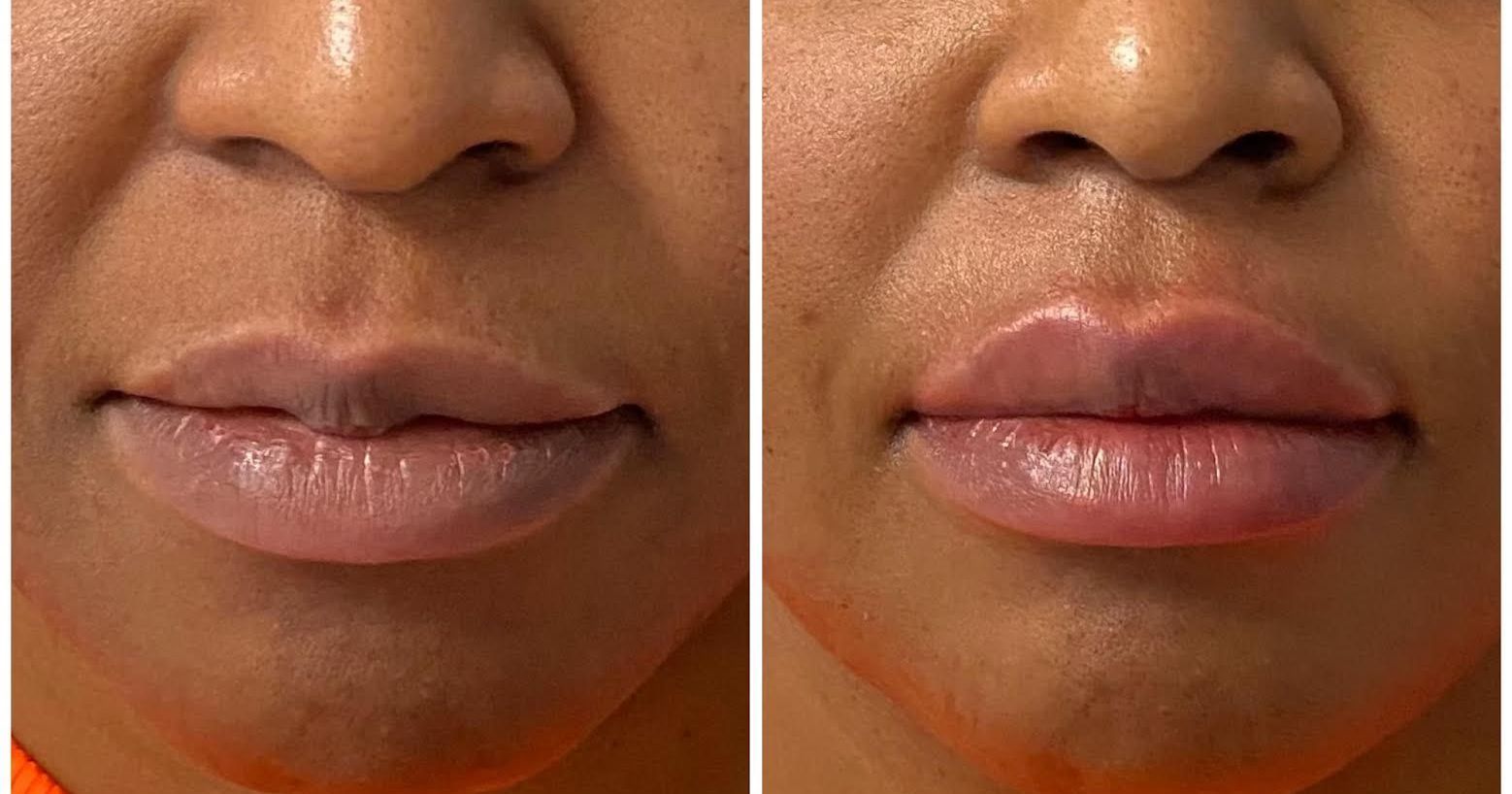 patient photos: before and after lip filler 