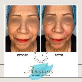 PATIENT PHOTO COMBINATION PDO THREAD CHEEK FILLER