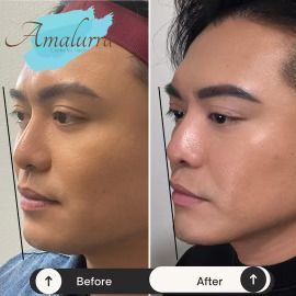 PATIENT PHOTO jaw and chin contouring with radiesse