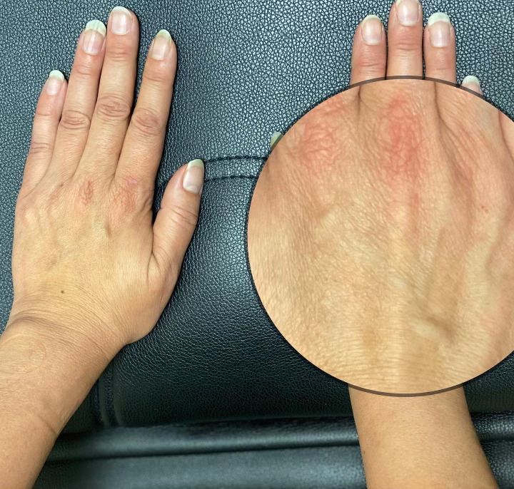 PATIENT PHOTO HAND REJUVENATION