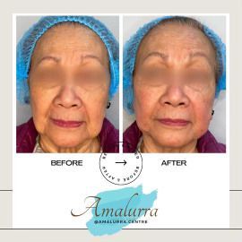 PATIENT PHOTO COMBINATION PDO THREAD CHEEK FILLER