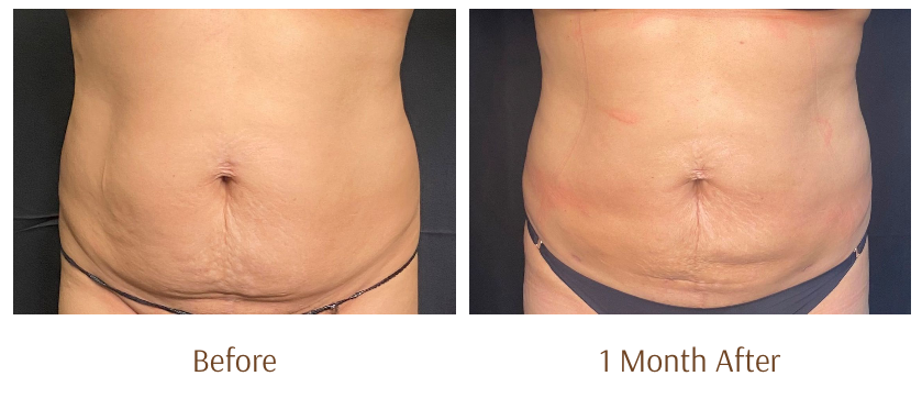 View of a woman's stomach is shown with a black background, before and after laser lipo treatment.