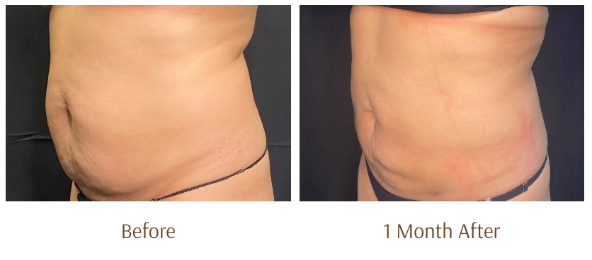 View of a woman's stomach is shown with a black background, before and after laser lipo treatment.