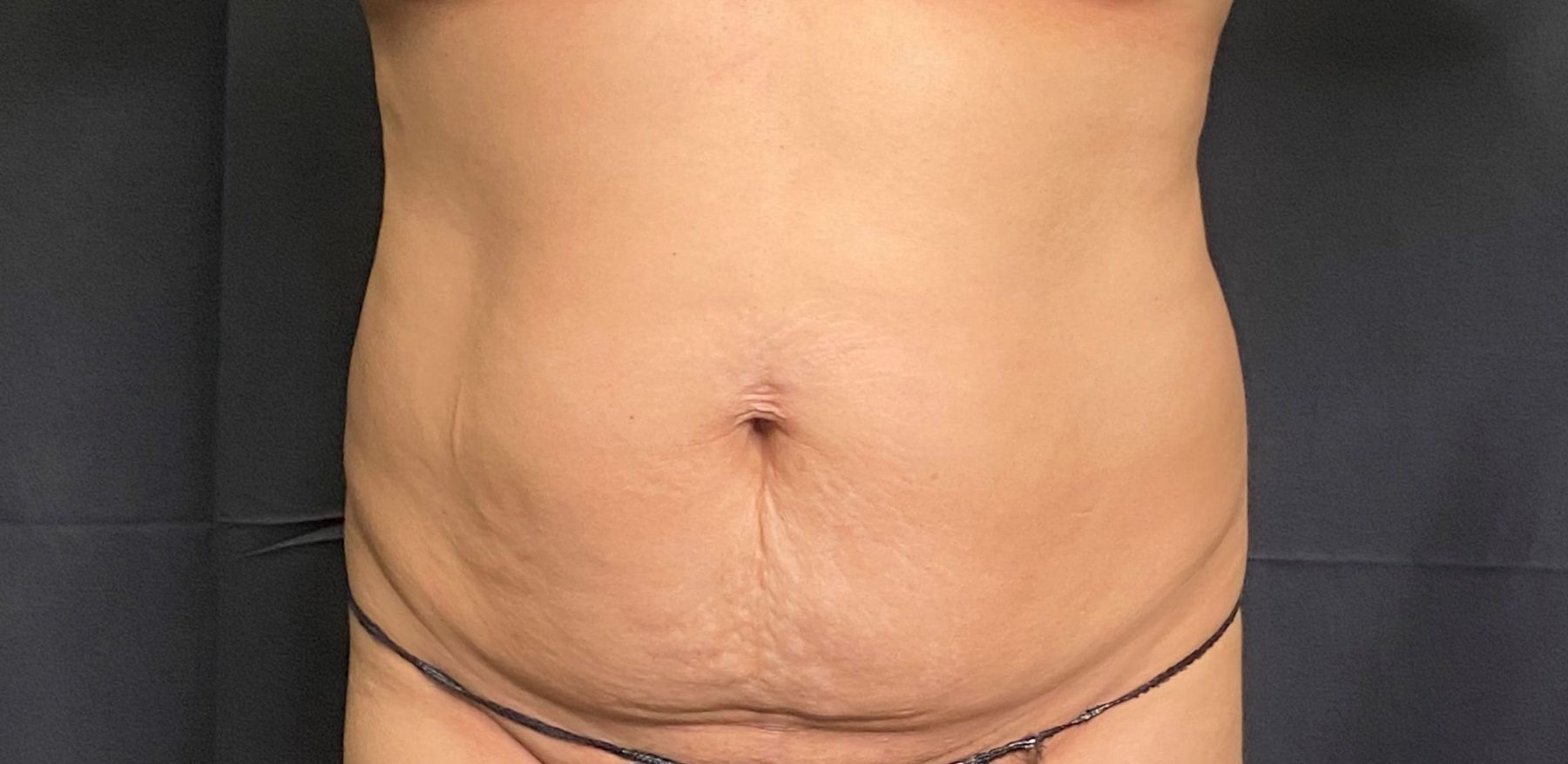 A woman's stomach is shown with a black background, before laser lipo treatment.