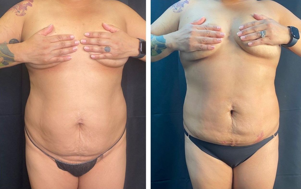 patient before and after treatment with BeautiFill laser for liposuction and fat transfer