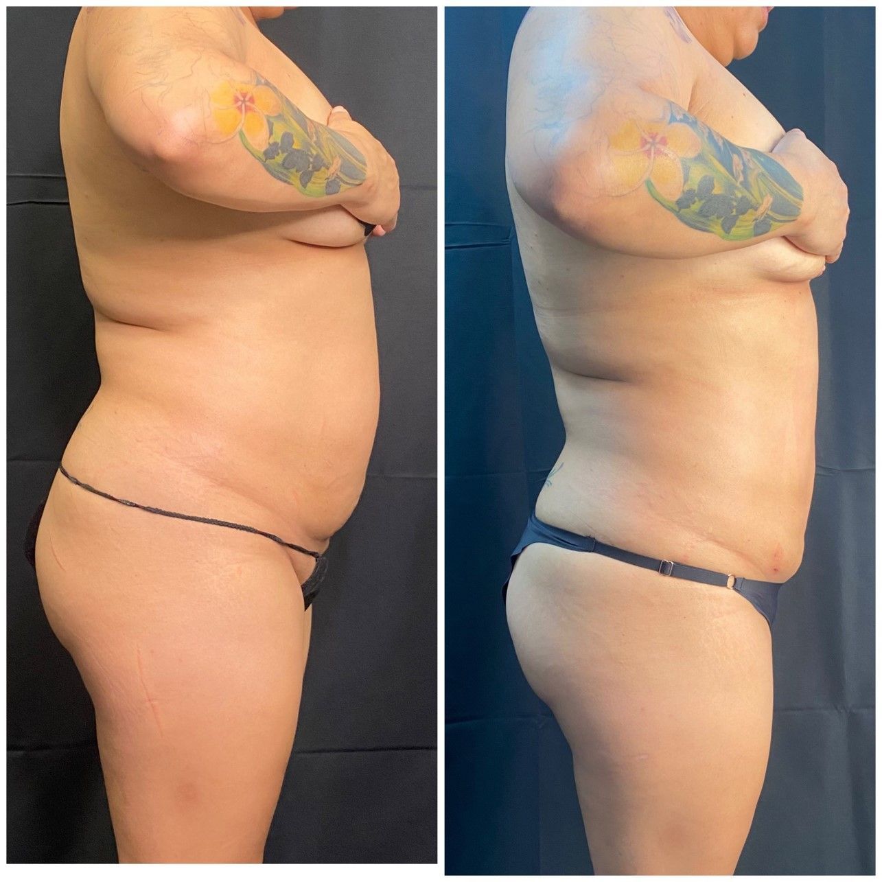 patient before and after treatment with BeautiFill laser for liposuction and fat transfer