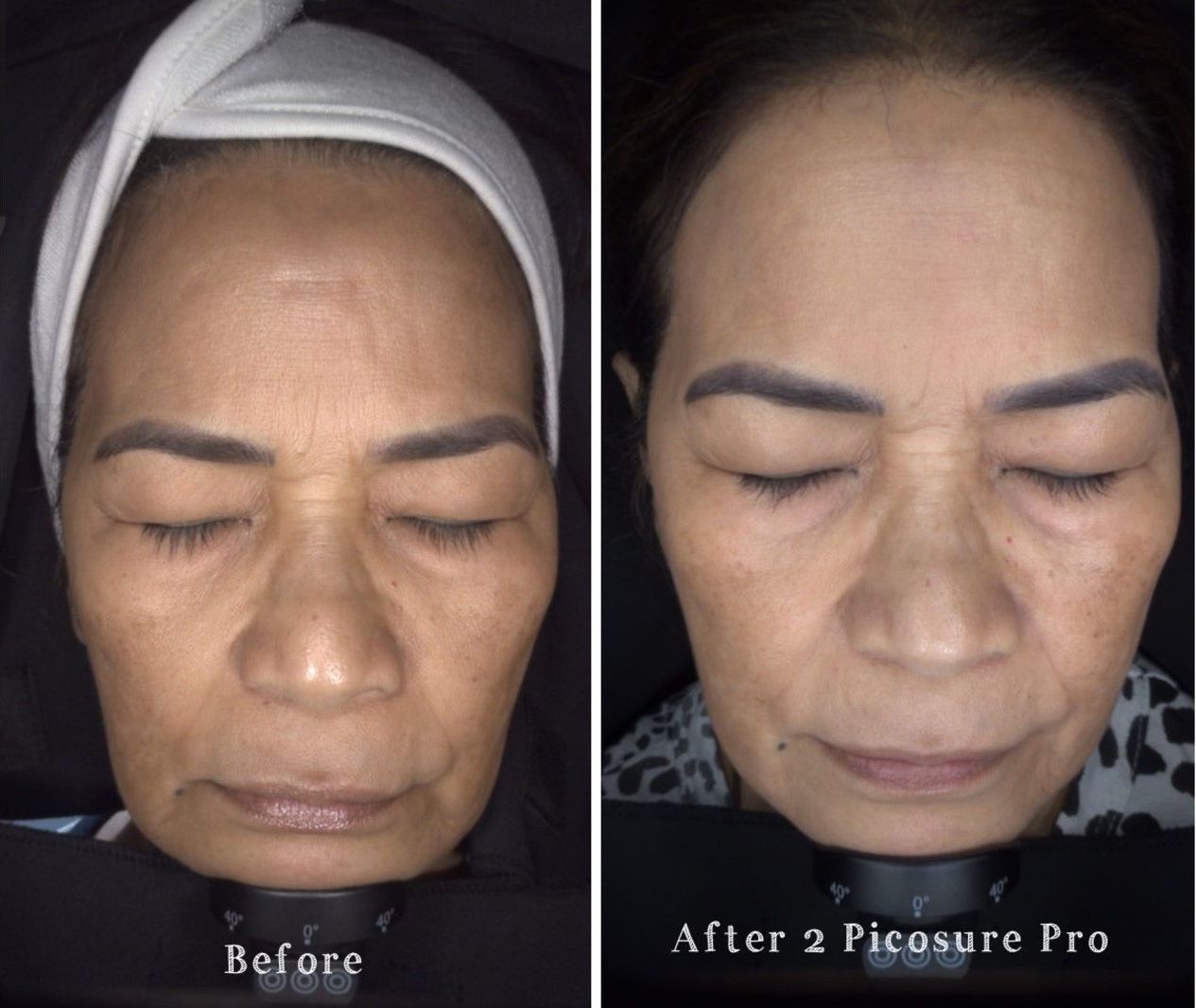 patient before and after treatment with PicoSure Pro laser for melasma and hyperpigmentation