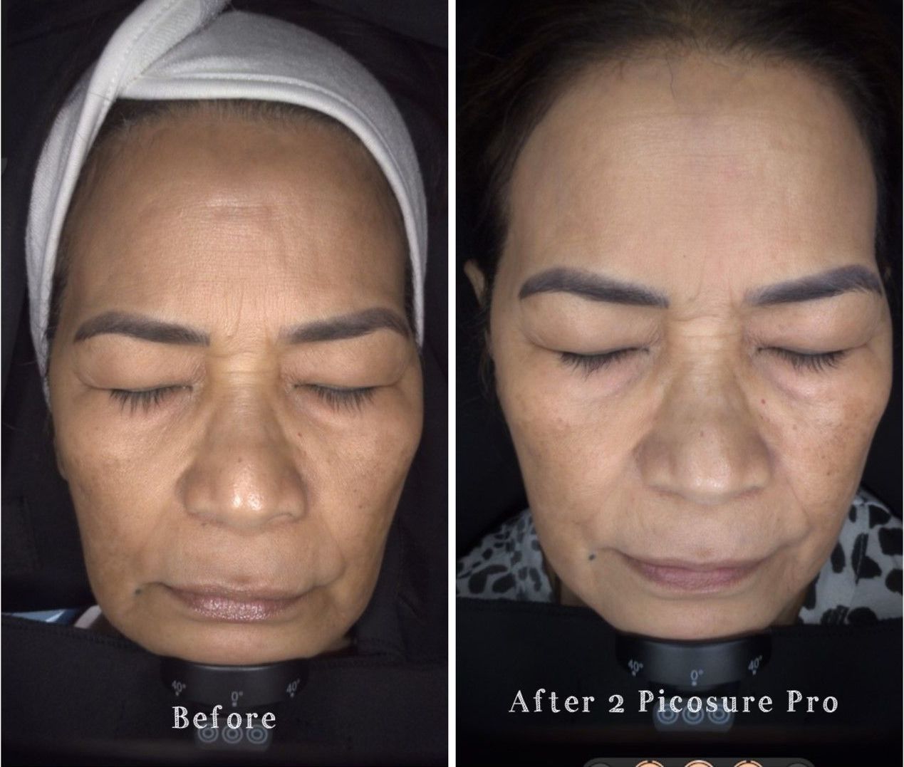 PATIENT PHOTO PIGMENT REMOVAL BY PICOSURE PRO