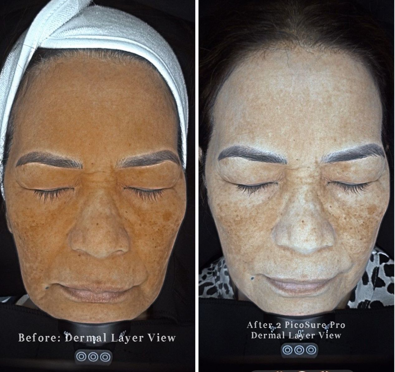 PATIENT PHOTO PIGMENT REMOVAL BY PICOSURE PRO