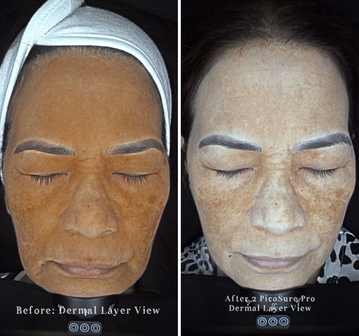 patient before and after treatment with PicoSure Pro laser for melasma and hyperpigmentation