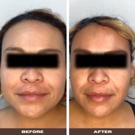 PATIENT PHOTO FACIAL CONTOURING WITH ULTHERA AND JAWTOX AFTER 2 MONTHS