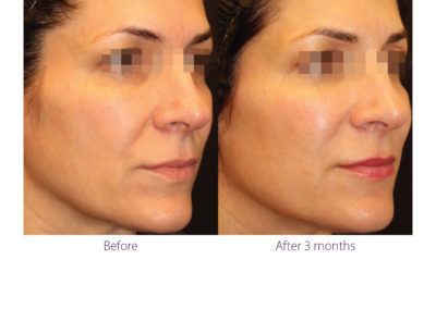 patient before and after treatment with BeautiFill laser for liposuction and fat transfer