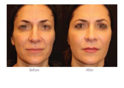 patient before and after treatment with BeautiFill laser for liposuction and fat transfer