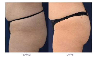 patient before and after treatment with BeautiFill laser for liposuction and fat transfer