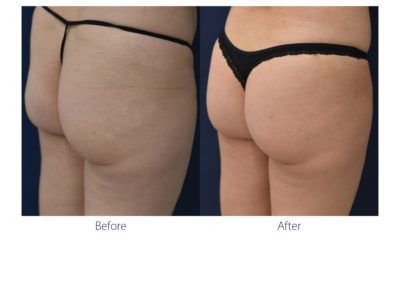 patient before and after treatment with BeautiFill laser for liposuction and fat transfer