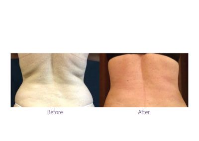 patient's body before and after BeautiFill laser lipo and fat transfer