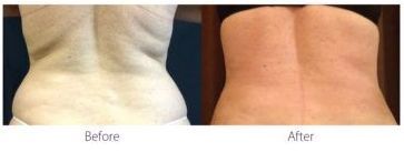 patient before and after treatment with BeautiFill laser for liposuction and fat transfer