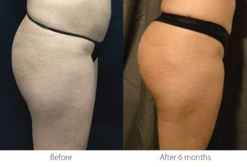 patient before and after treatment with BeautiFill laser for liposuction and fat transfer