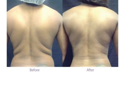 patient's body before and after BeautiFill laser lipo and fat transfer