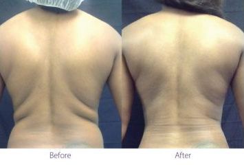 patient before and after treatment with BeautiFill laser for liposuction and fat transfer