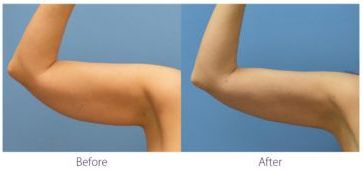 patient before and after treatment with BeautiFill laser for liposuction and fat transfer