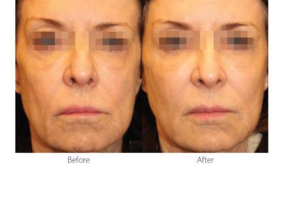 patient before and after treatment with BeautiFill laser for liposuction and fat transfer