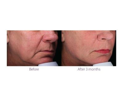 patient before and after treatment with BeautiFill laser for liposuction and fat transfer