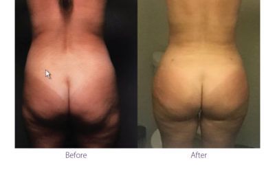 patient before and after treatment with BeautiFill laser for liposuction and fat transfer