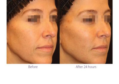 patient before and after treatment with BeautiFill laser for liposuction and fat transfer