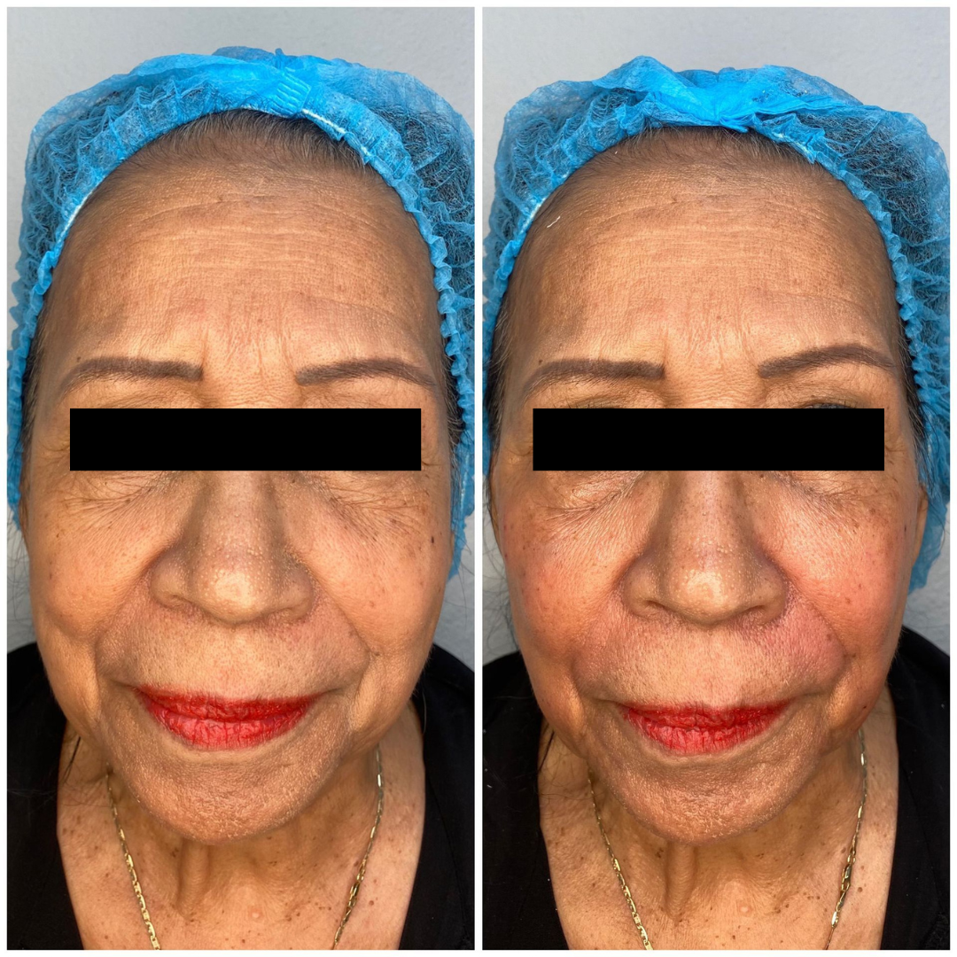 patient photo - CHEEK AND NASOLABIAL FOLD FILLER