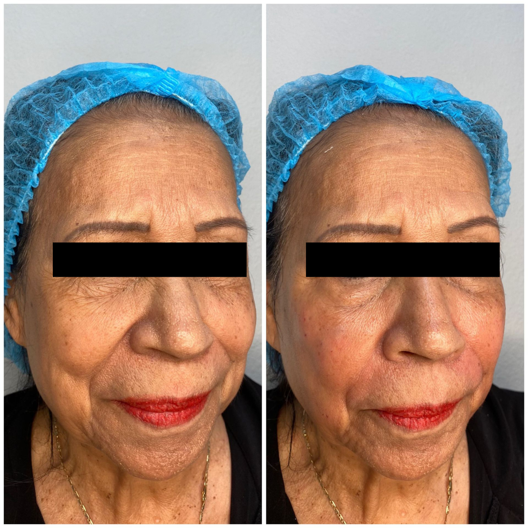 patient photo - CHEEK AND NASOLABIAL FOLD FILLER