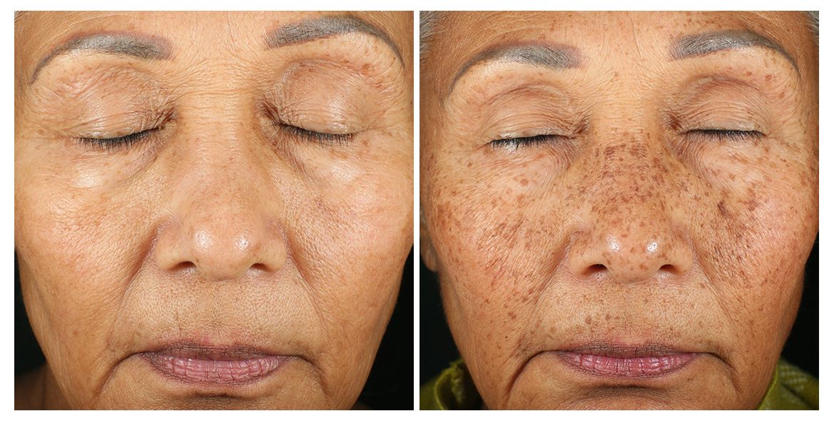 patient before and after treatment with PicoSure Pro laser for melasma and hyperpigmentation
