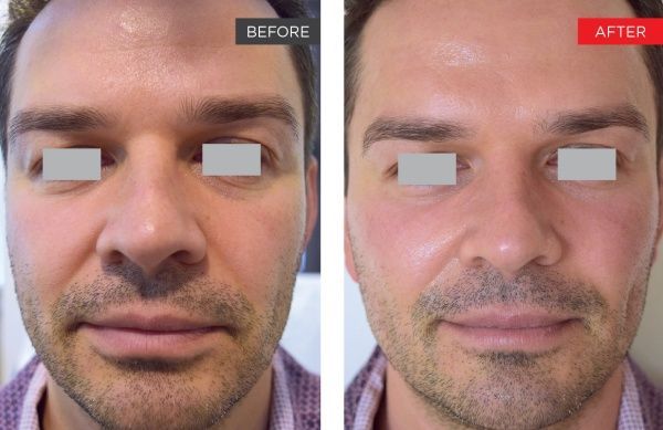 real patient shown before and after treatment with Fotona laser