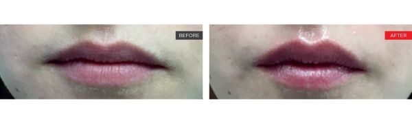 real patient before and after treatment with Fotona laser