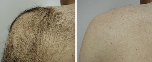 real patient shown before and after treatment with Fotona laser