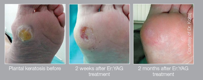 Laser removal of keratosis on foot before and after photos