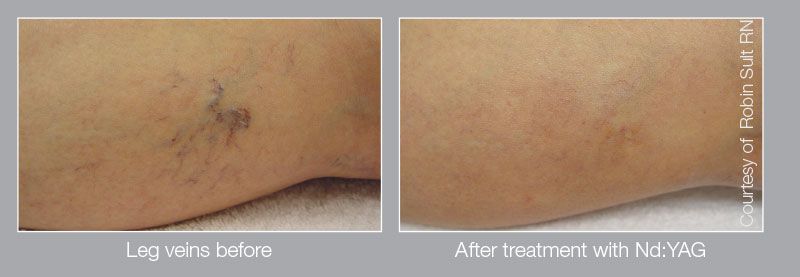 Vascular lesions - before and after photo