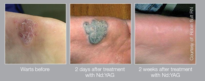 Foot wart before and after photos